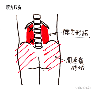 腰方形筋のトリガーポイントと関連痛領域